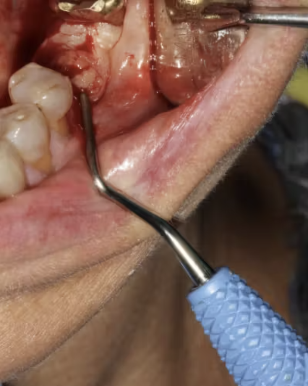 Nguyên tắc vàng khi tái cấy implant sau thất bại